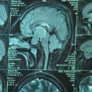 Астраханские хирурги спасли мать восьмерых детей сложной операцией на головном мозге